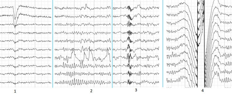 EEG (1)